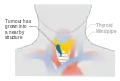 Stage T4a thyroid cancer
