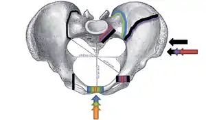 Superior view, Pelvic Fracture Types (2006).
Force and break are shown by matching color:
Anteroposterior compression type I (orange), Anteroposterior compression type II (green), Anteroposterior compression type III (blue); Lateral compression type I (red), Lateral compression type II (purple), F. Lateral compression type III (black).
Increased force and breaks are shown by increasing size.