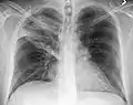 Right upper lobe pneumonia as marked by the circle.